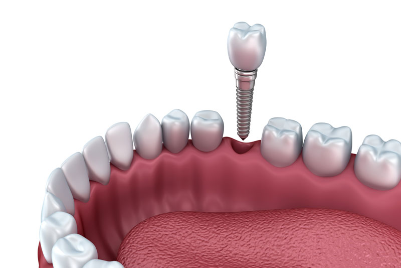a single dental implant and post being placed into a lower jaw.