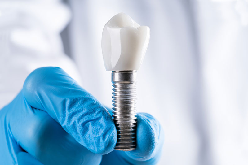 picture of a dentist's surgical gloved hand holding a single dental implant by the post.