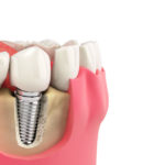 a single dental implant placed in a jawbone 3d model.