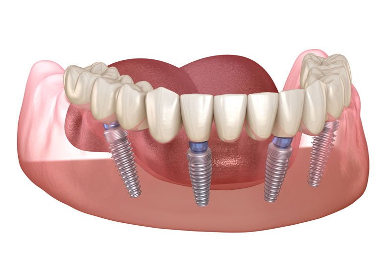 an image of an all-on-4 dental implant model that has four dental implant posts and a full arch prosthetic that can benefit a patients smile in many ways.