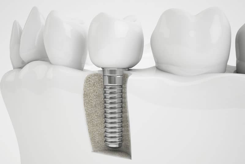 Want To Know Why You May Need A Bone Grafting Procedure Before Your Dental Implant Surgery? We Can Help You With That!