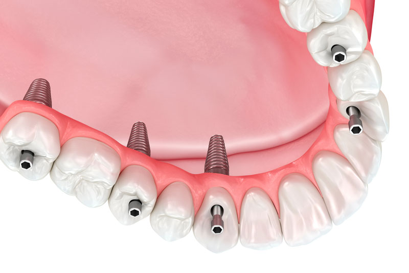 If I Don’t Get Dental Implants To Replace My Teeth, What Can Happen?