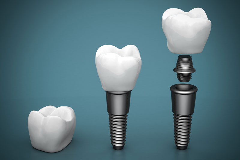 a series of dental implant models showing the abutement, post, and dental crown.