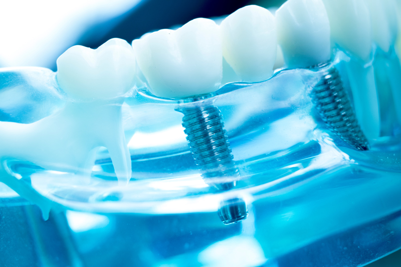Can Dental Implants Give Me A Permanent New Smile?