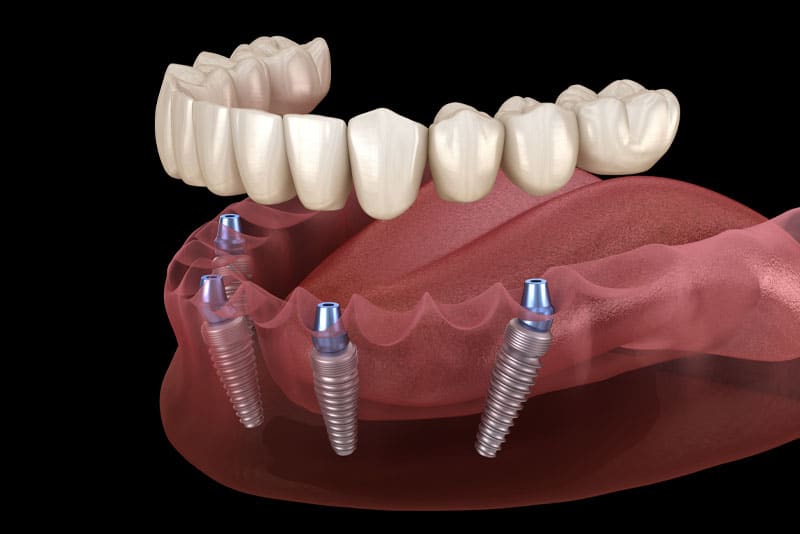 a full mouth dental implant model showing how patients can get treated with personalized full mouth dental implants through strategic dental implant angling and placement.