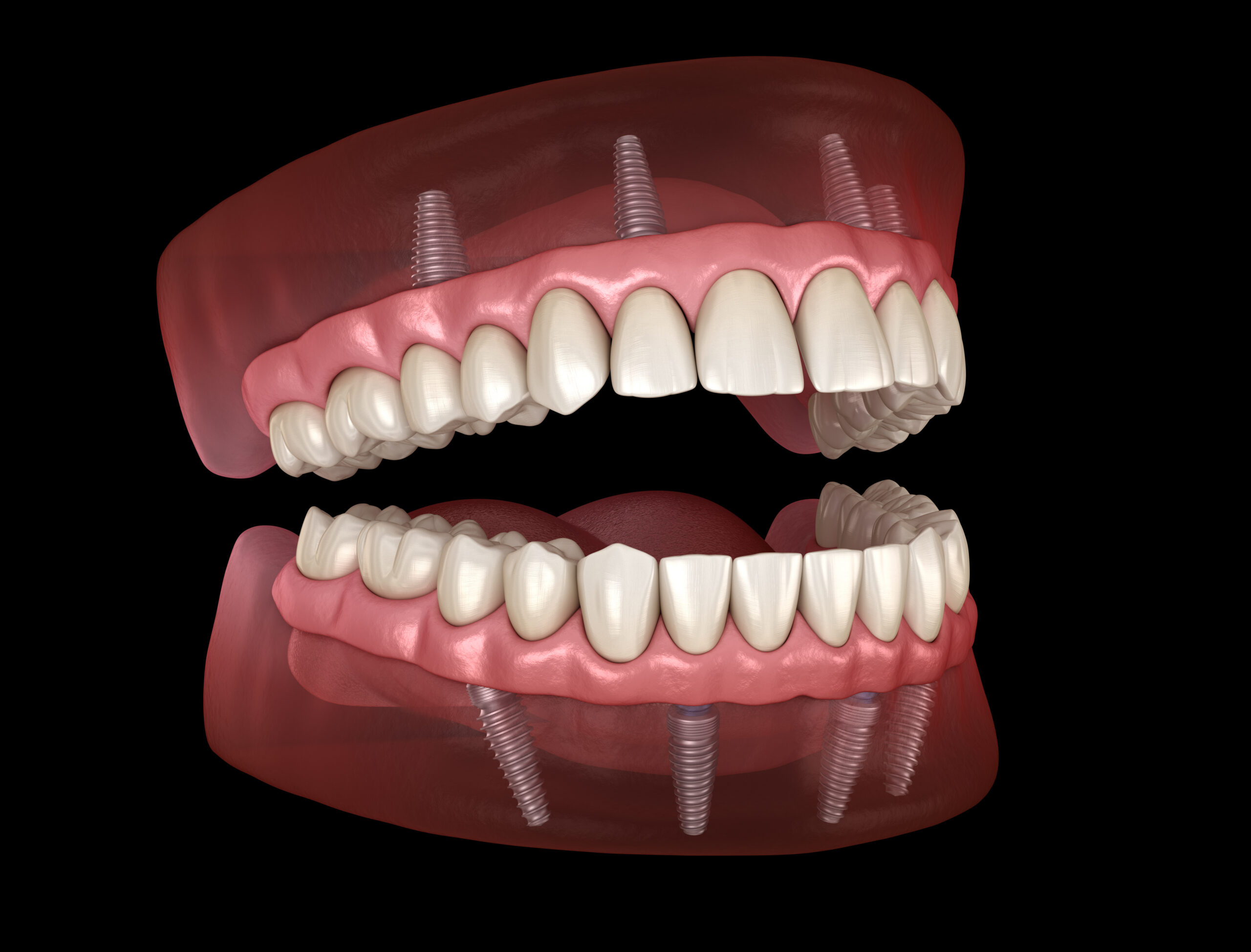 Maxillary and Mandibular prosthesis with gum All on 4 system supported by implants. Medically accurate 3D illustration of human teeth and dentures.