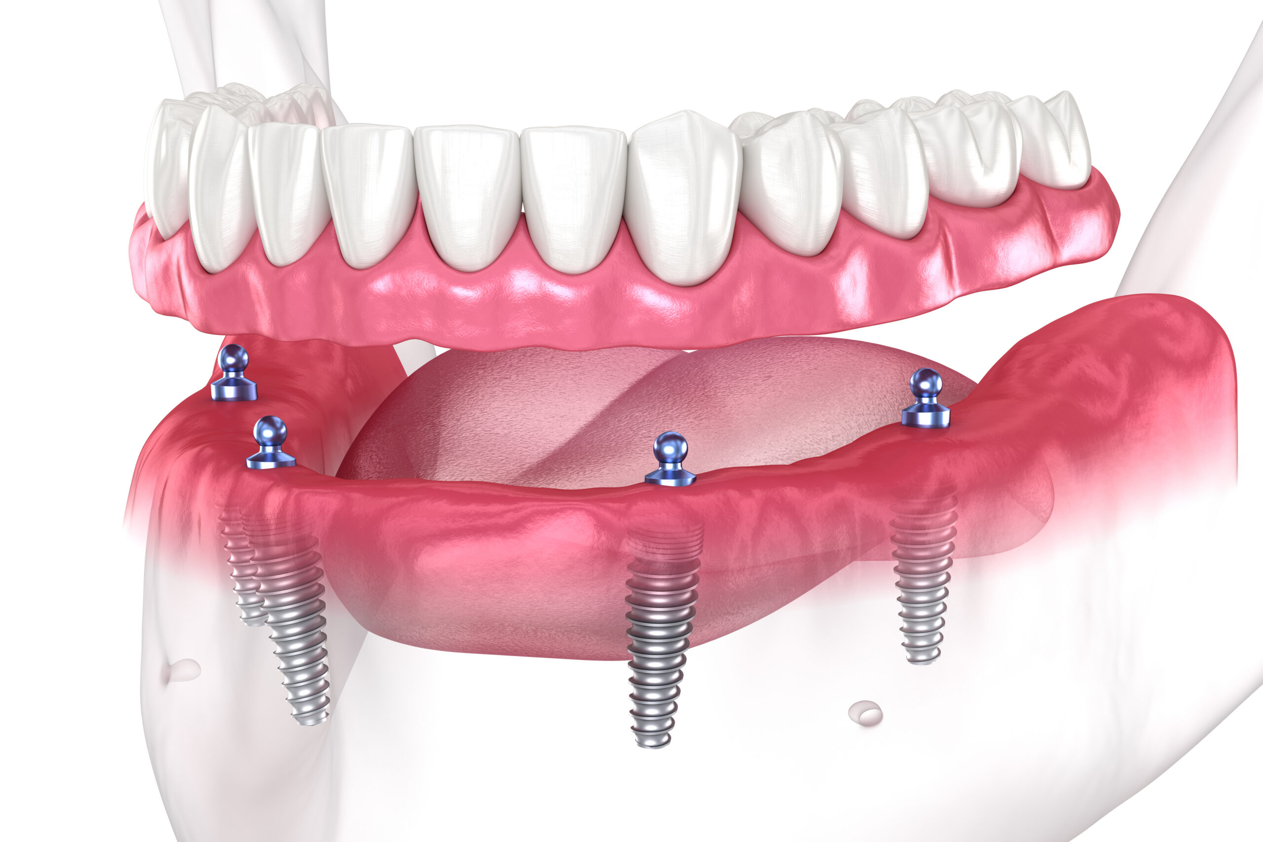 Can I Have A Cost-Effective New Smile With Full Mouth Dental Implants In East Lansing, MI?