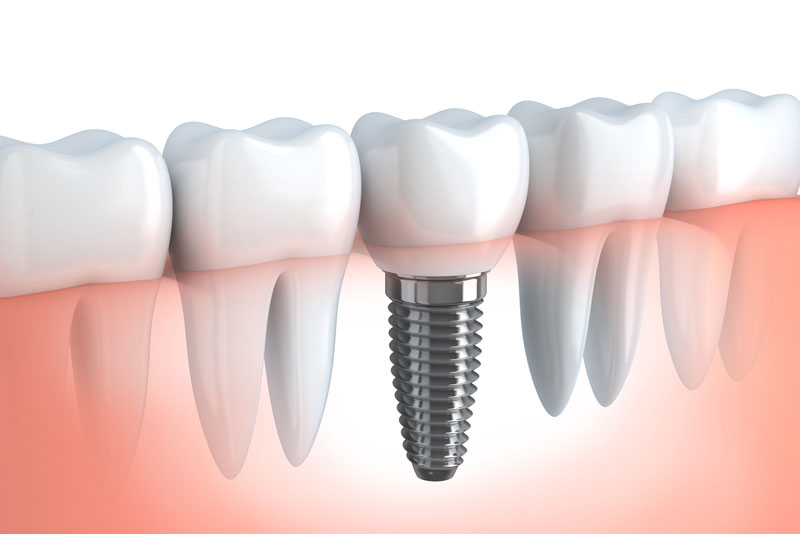 an image of dental implant.