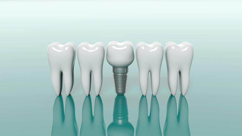 Do I Need A Full Mouth Dental Implant Consultation?