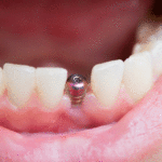 close up shot of a patient’s mouth with a single implant.