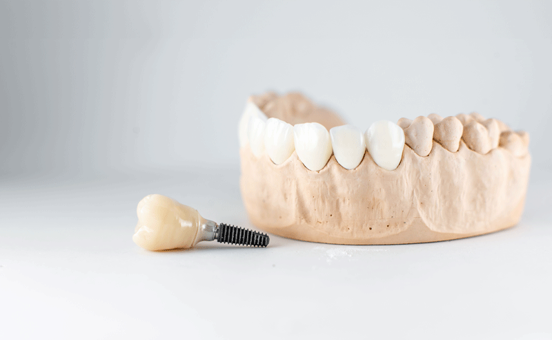 Are There Side Effects To Dental Implant Procedures?