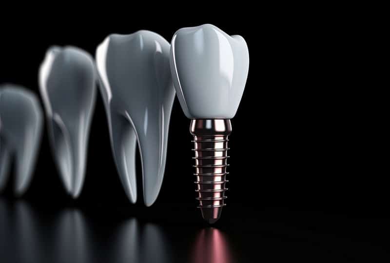 Are There Risks To Getting Treated With Dental Implants?
